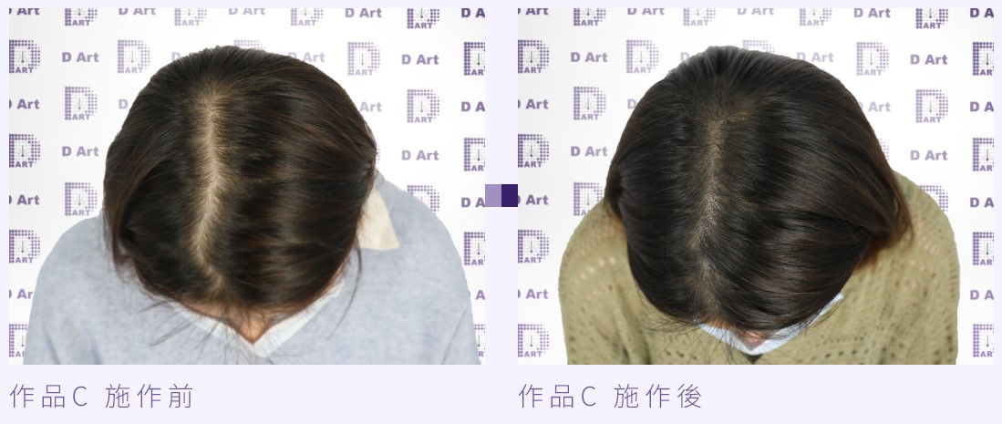 無針擬真繡髮案例C